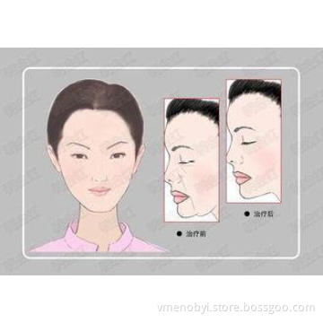 Cooling RF Skin Rejuvenation Thermage Fractional RF Cavitat